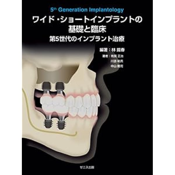 多数歯欠損無歯顎欠損のインプラント治療 無歯顎多数歯欠損症例におけるインプラント治療 - YouTube